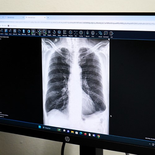 Saúde pública de VR ultrapassa 50 mil exames analisados com auxílio da Inteligência Artificial